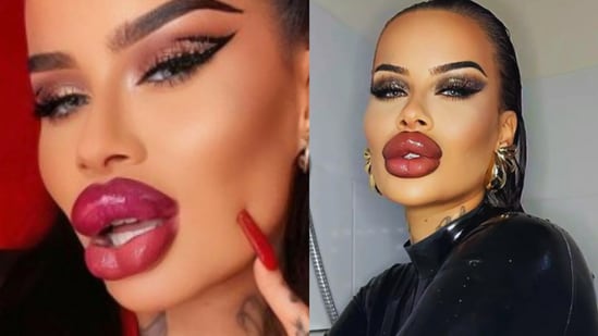 ‘I am addicted to filler, Botox’: 30-year-old OnlyFans star spends ₹53 lakh to look like ‘Barbie for life’