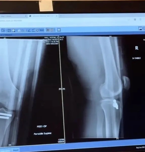 Post-operative X-rays of a knee.