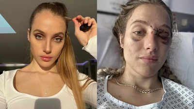 Neuroscientist-turned-OnlyFans model ‘can’t remember’ who she is, after a near-fatal bike accident | – The Times of India